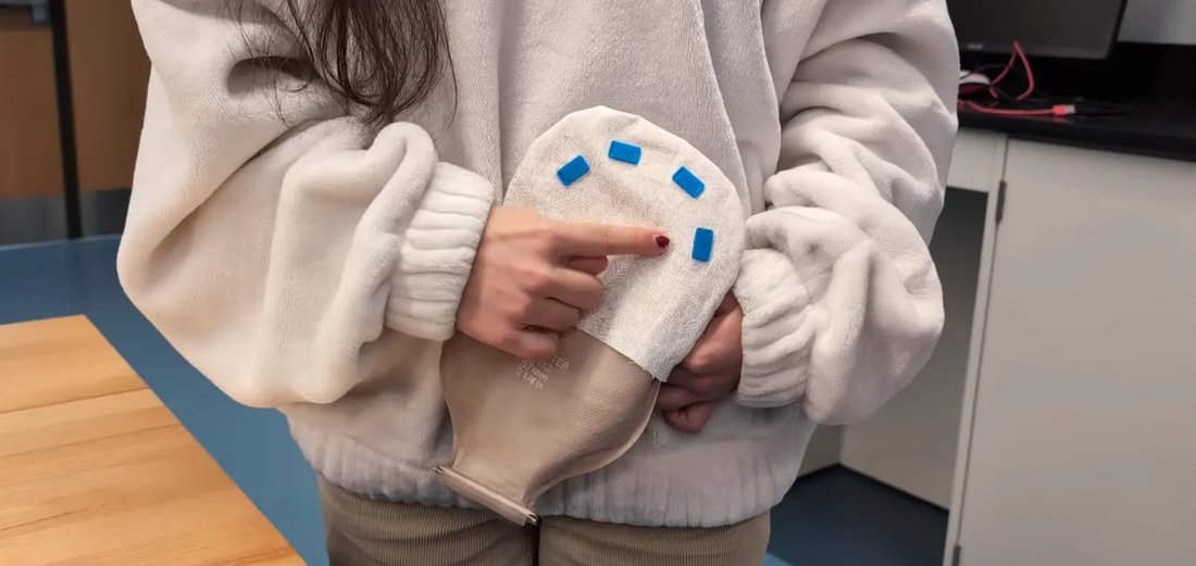 OstoFlow prototype ostomy pouch, worn, showing the dual-layer design and charcoal filter tabs